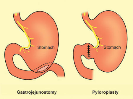 گاستروژیونوستومی چیست, گاستروژژنوستومی لوپ