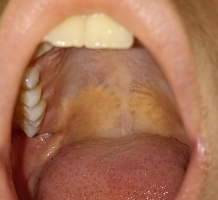 زرد شدن سقف دهان, علت زردی دهان