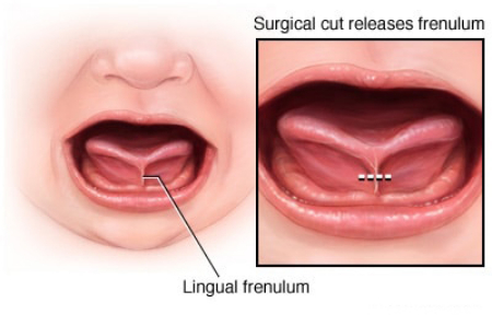 چسبندگی زبان چیست, عمل چسبندگی زبان
