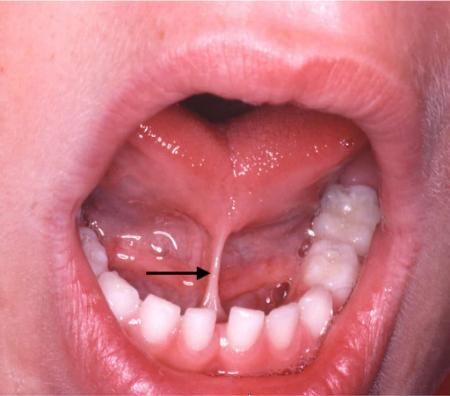 چسبندگی زبان چیست, عمل چسبندگی زبان