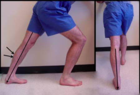 درمان تاندونیت آشیل, تمرینات اکسنتریک آشیل