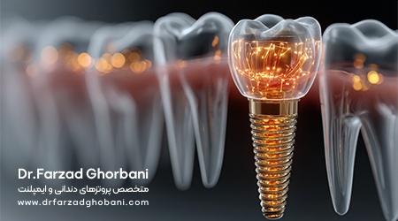 مراحل انجام ایمپلنت دندانی-دکتر فرزاد قربانی