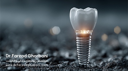 کاشت ایمپلنت-دکتر فرزاد قربانی متخصص پروتزهای دندانی و ایمپلنت