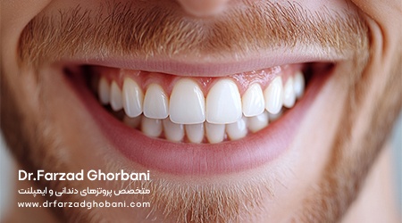 درمانهای موفق ایمپلنت-دکتر فرزاد قربانی