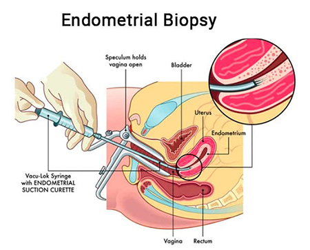 نحوه انجام بیوپسی آندومتر
