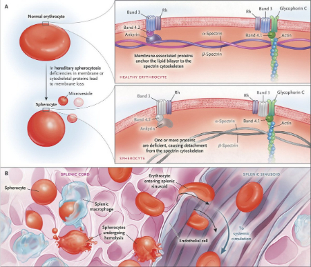 اسفروسیتوز ارثی, درمان اسفروسیتوز