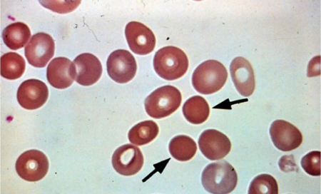 اسفروسیتوز ارثی, درمان اسفروسیتوز