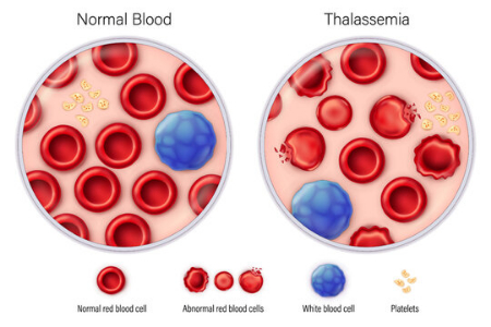 اسفروسیتوز ارثی, درمان اسفروسیتوز