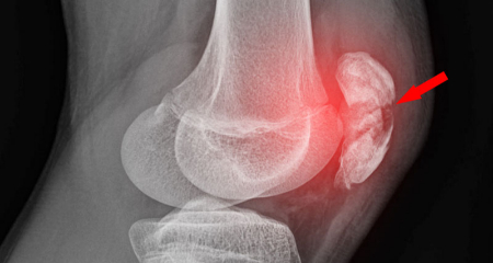 مشکلات و درمان‌های کاسه زانو, التهاب تاندون پاتلار