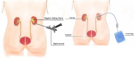 نفرولیتوتومی از راه پوست, بهبودی پس از PCNL