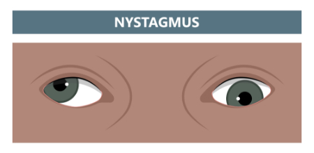نیستاگموس چیست, نیستاگموس در کودکان
