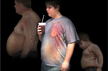 سندرم پرادر-ویلی چیست, مشکلات ژنتیکی پرادر-ویلی