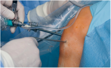 جراحی تاندون شانه, بهبودی پس از جراحی تاندون شانه