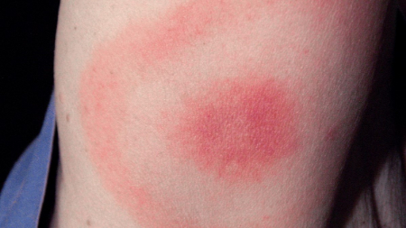 بیماری منتقله توسط کنه, پیشگیری از گزش کنه