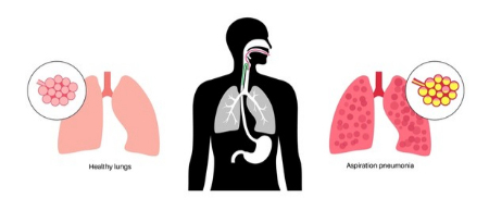 پنومونی آسپیراسیون, پیشگیری از پنومونی آسپیراسیون