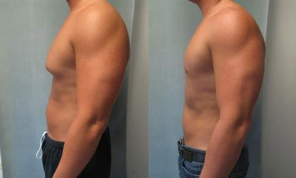 درمان ژنیکوماستی با ورزش,درمان ژنیکوماستی,افتادگی سینه مردان