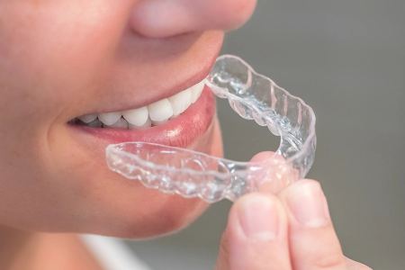 روش جدید ارتودنسی با الاینرهای شفاف