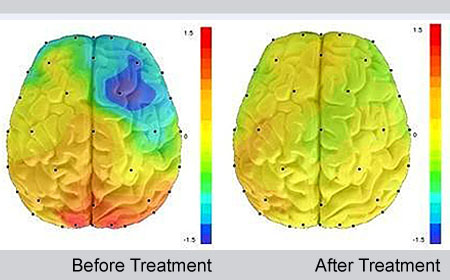 درمان افسردگی, راههای درمان افسردگی, درمان افسردگی بدون دارو