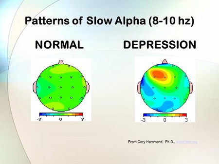 درمان با نوروفیدبک, معالجه افسردگی توسط نوروفیدبک, درمان افسردگی با نوروتراپی