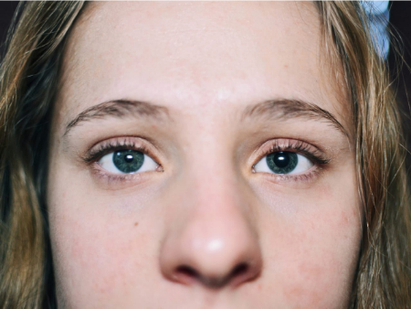 سندرم آدی, مردمک تونیک