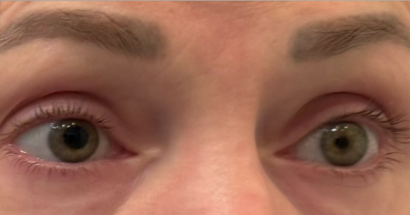 سندرم آدی, مردمک تونیک