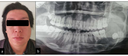 آملوبلاستوما, درمان آملوبلاستوما