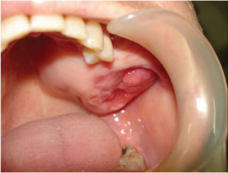 آملوبلاستوما, درمان آملوبلاستوما