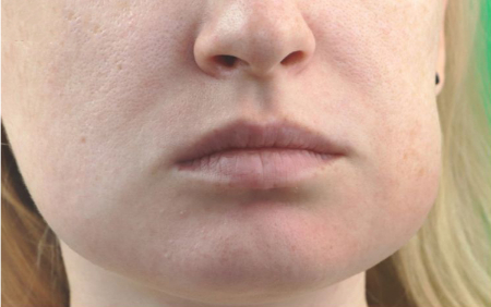 آملوبلاستوما, درمان آملوبلاستوما