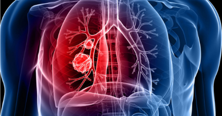 سرطان ریه و کمردرد, علل کمردرد در سرطان ریه