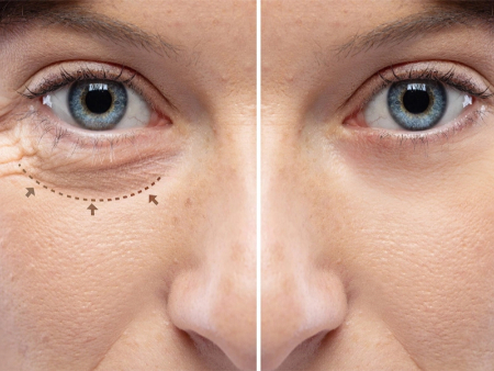 مقایسه نتایج بلفاروپلاستی و پتوز پلک