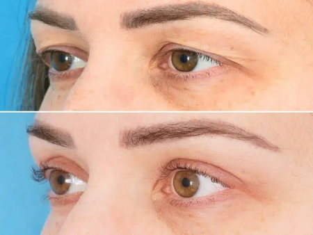 تشخیص بین بلفاروپلاستی و پتوز پلک