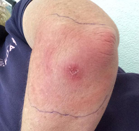 گزیدگی مگس اسب, عفونت گزیدگی مگس اسب