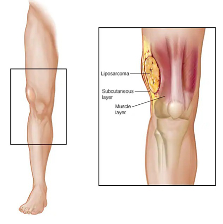 لیپوسارکوما چیست, لیپوسارکومای بدتمایز