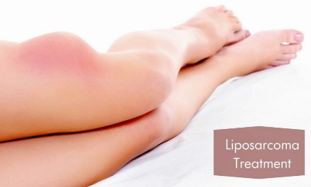 لیپوسارکوما چیست, لیپوسارکومای بدتمایز