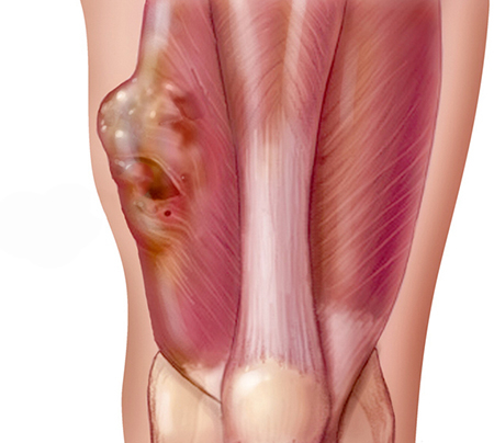 لیپوسارکوما چیست, لیپوسارکومای بدتمایز