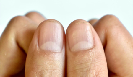 ناخن‌های کووید, علائم کووید روی ناخن