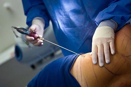  مزایای لیپوساکشن با دستگاه پال, لیپوساکشن با دستگاه پال