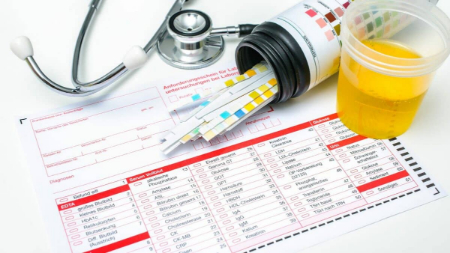 آزمایش پروتئین ادرار چیست, تست پروتئین ادرار