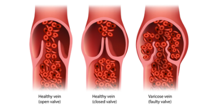 وریدهای واریسی, مکمل برای وریدهای واریسی