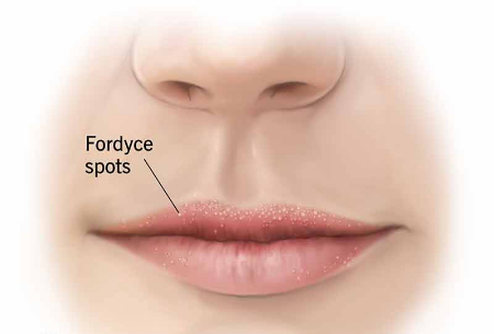 برجستگی سفید روی لب, درمان خانگی جوش لب