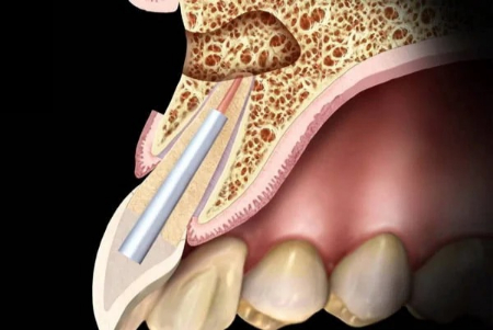 آپیکوکتومی دندانی, تفاوت آپیکوکتومی و عصب‌کشی