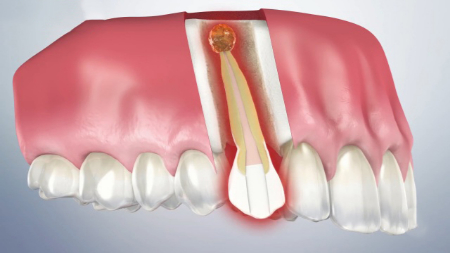 آپیکوکتومی دندانی, تفاوت آپیکوکتومی و عصب‌کشی