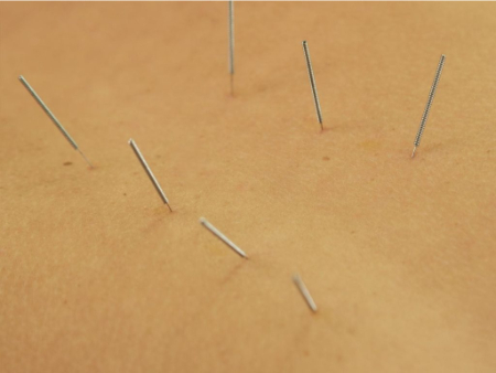 سوزن‌زنی خشک برای ورزشکاران, مزایای درای نیدلینگ