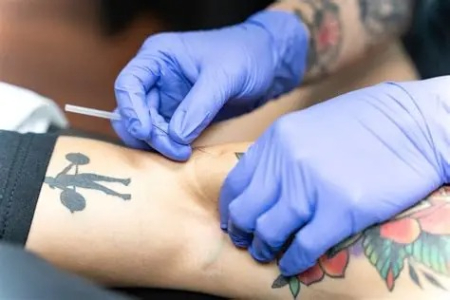 سوزن‌زنی خشک برای ورزشکاران, مزایای درای نیدلینگ