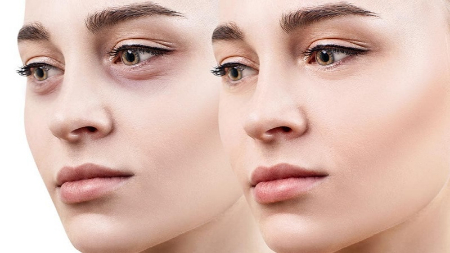 جراحی بینی گوشتی, جراحی بینی استخوانی