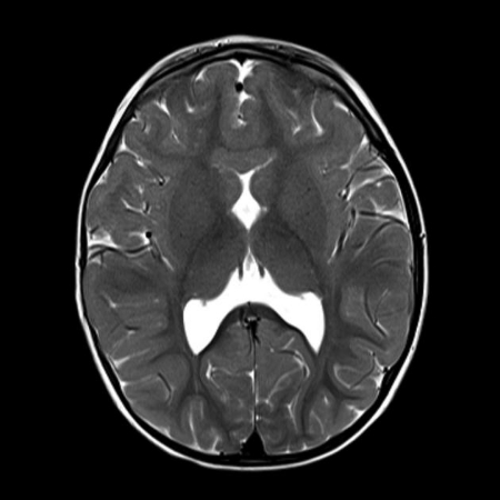 هولوپروزنسفالی, لوبار هولوپروزنسفالی