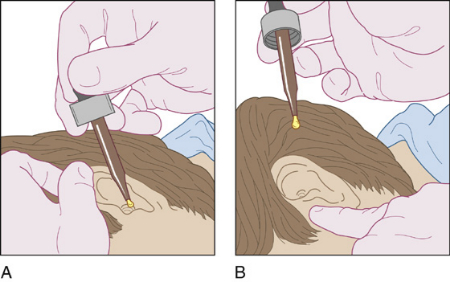 حشره در گوش, درمان حشره در گوش