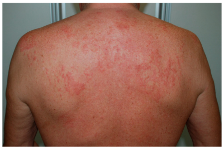 کهیر فشاری چیست, کهیر پوستی