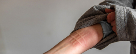 کهیر فشاری چیست, کهیر پوستی