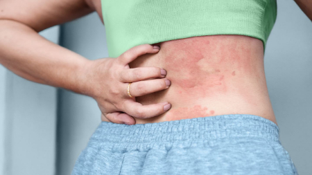 کهیر فشاری چیست, کهیر پوستی